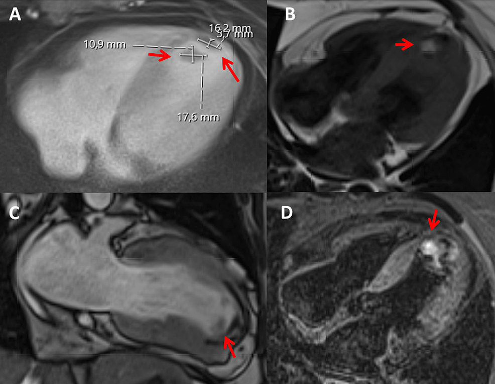 Hereditary Protein S Deficiency and Activated Protein C Resistance