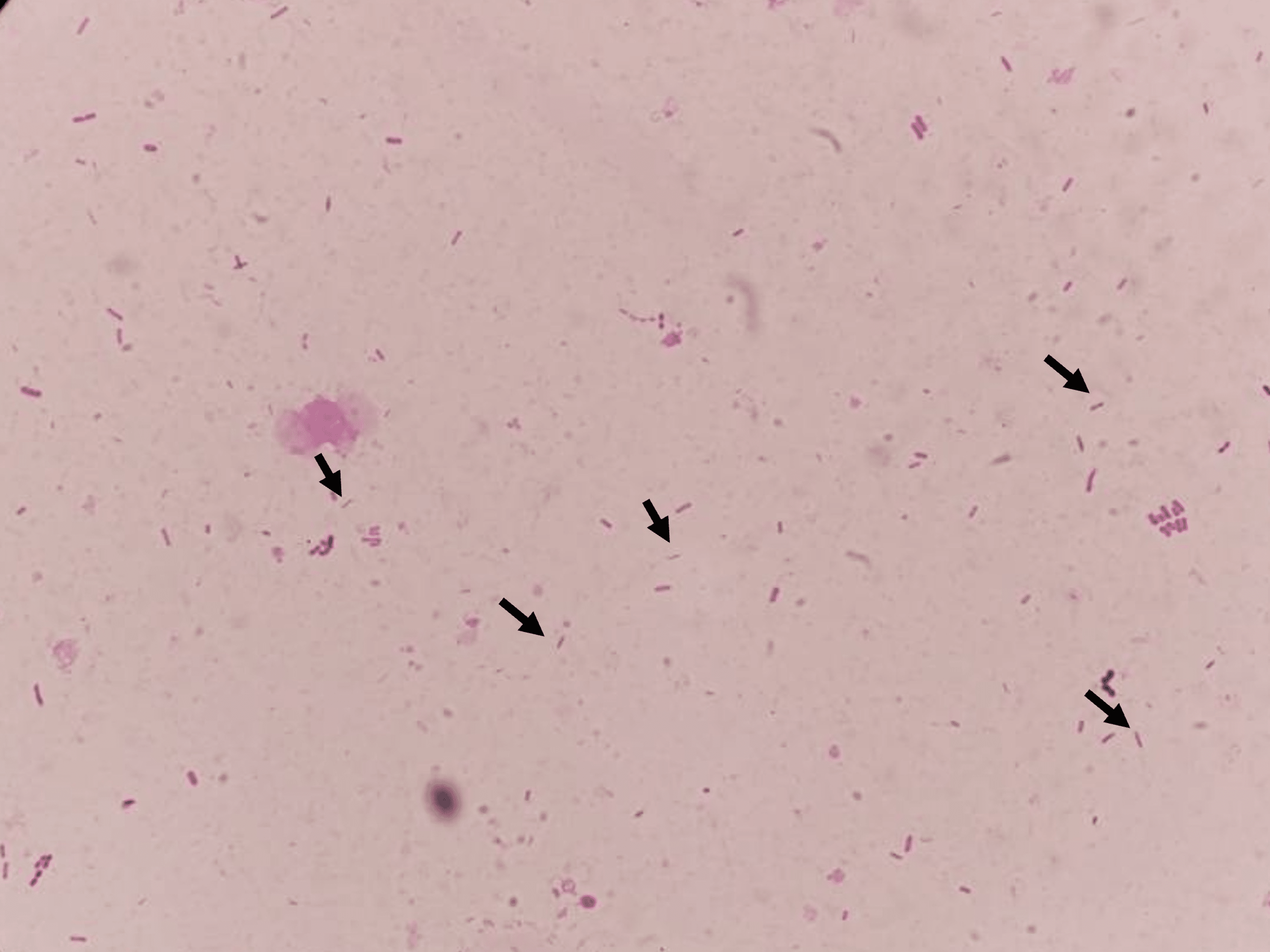 A Case of Pseudoappendicitis Caused by Campylobacter Enteritis