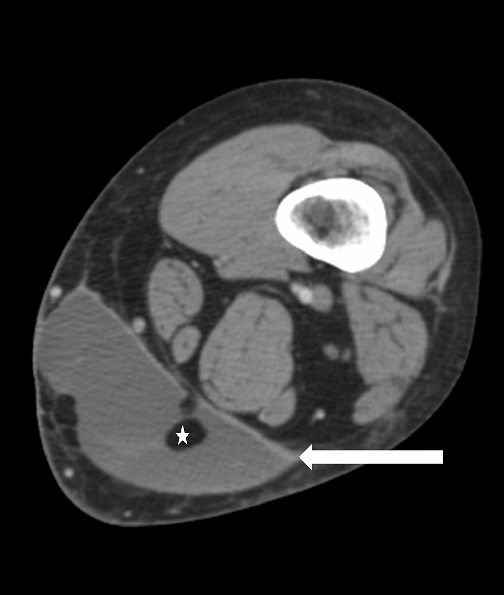 MorelLavallee Lesion A Case of Lower Extremity Internal Degloving Injury Cureus