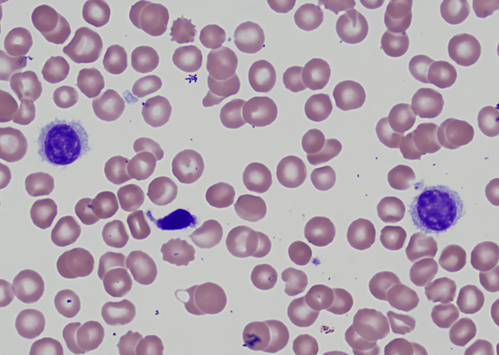 nucleated red blood cells