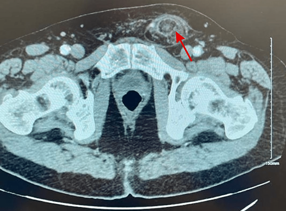 cureus-a-rare-case-of-incarcerated-inguinal-hernia-containing-fat-and