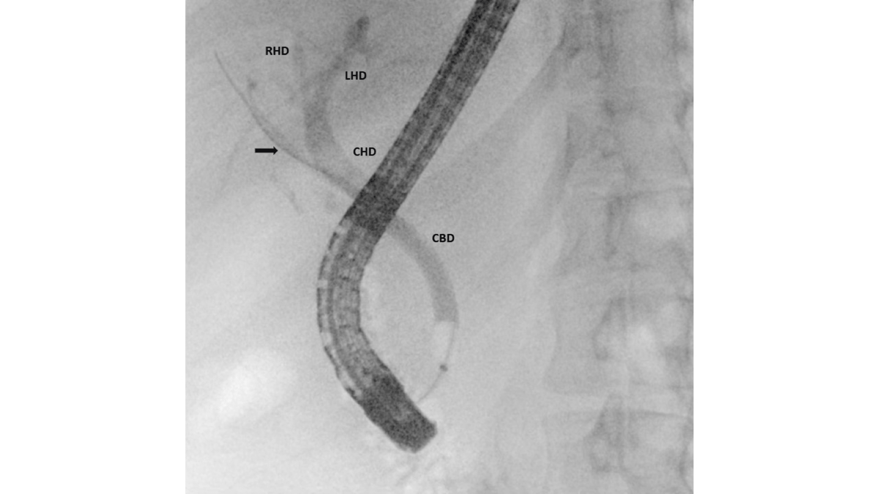 Cureus | Variant Biliary Anatomy in Biological Siblings