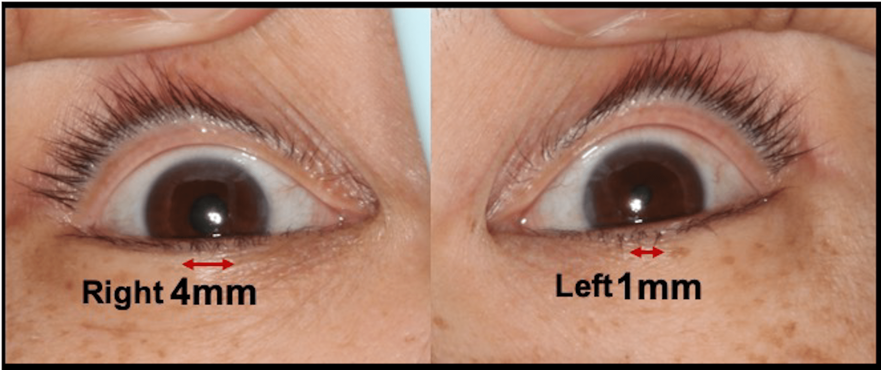 A Case of Surgery Cancellation Following the Discovery of Anisocoria