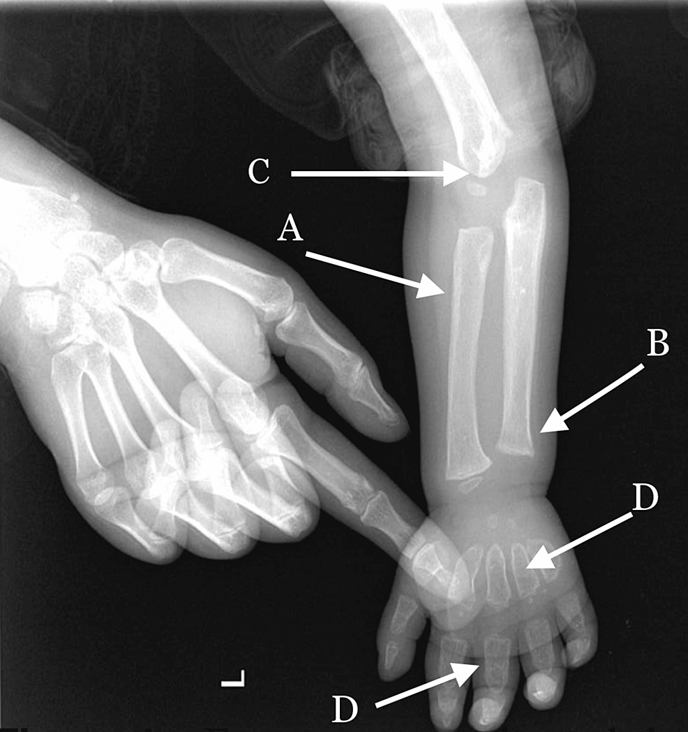 cureus-mucopolysaccharidosis-type-vi-with-recurrent-chest-infection