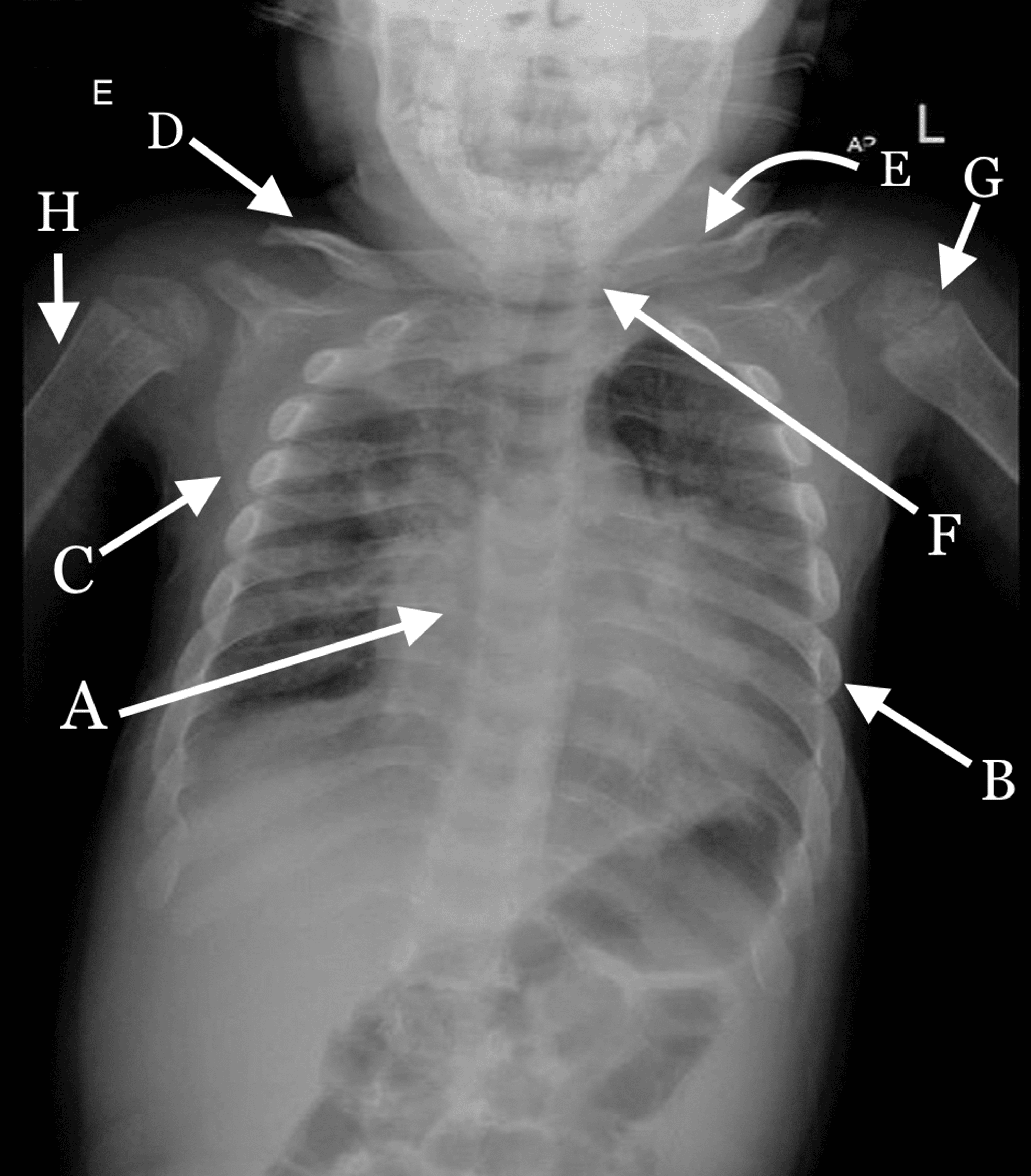 Cureus Mucopolysaccharidosis Type VI with Recurrent Chest Infection