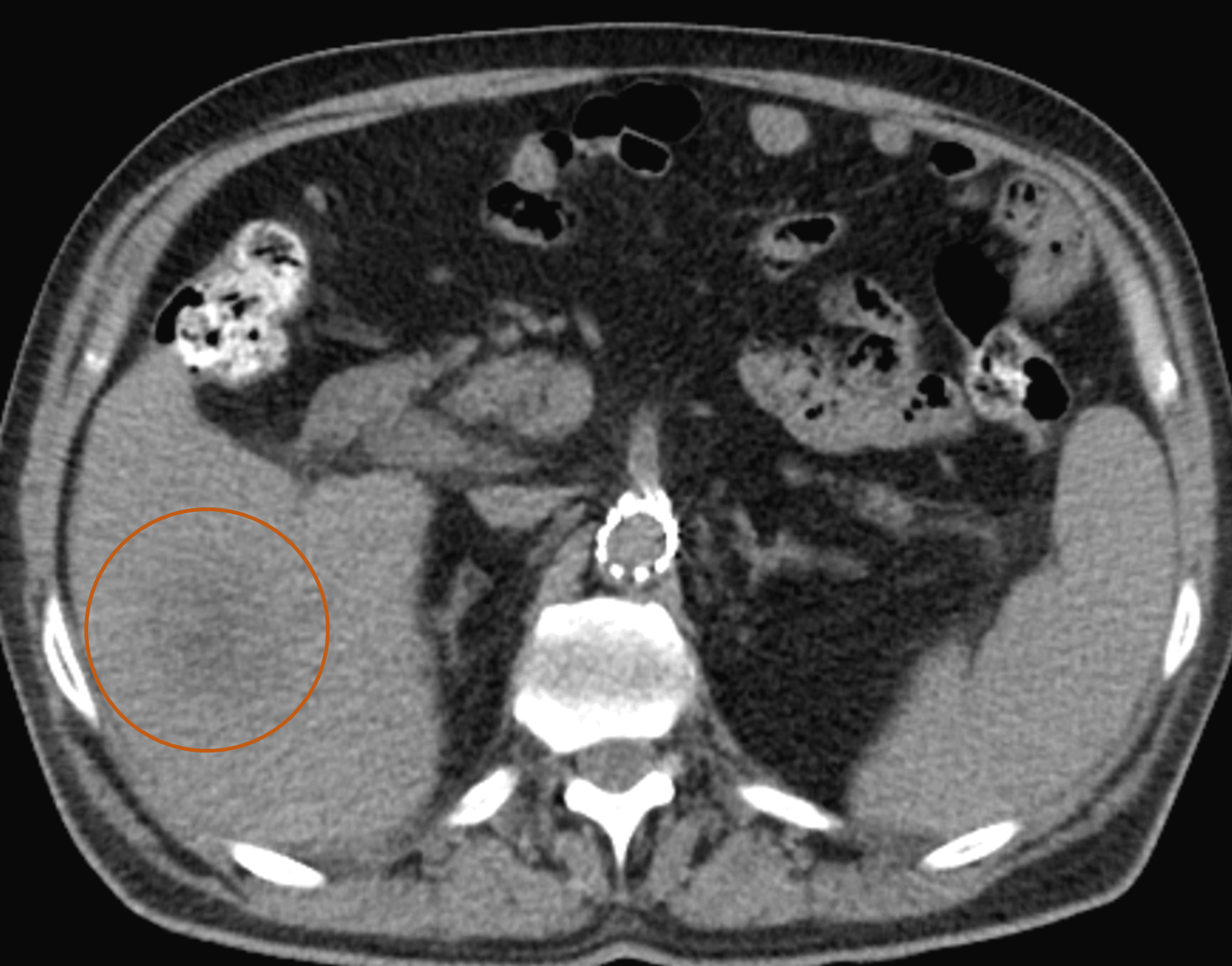 Recurrent Liver Abscess in a Nontoxic Patient Cureus
