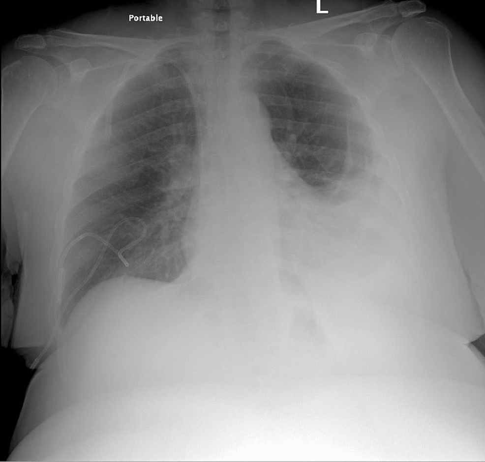 Cureus Malignant Pleural Effusion Due To Uterine Serous Carcinoma An Unusual Presentation