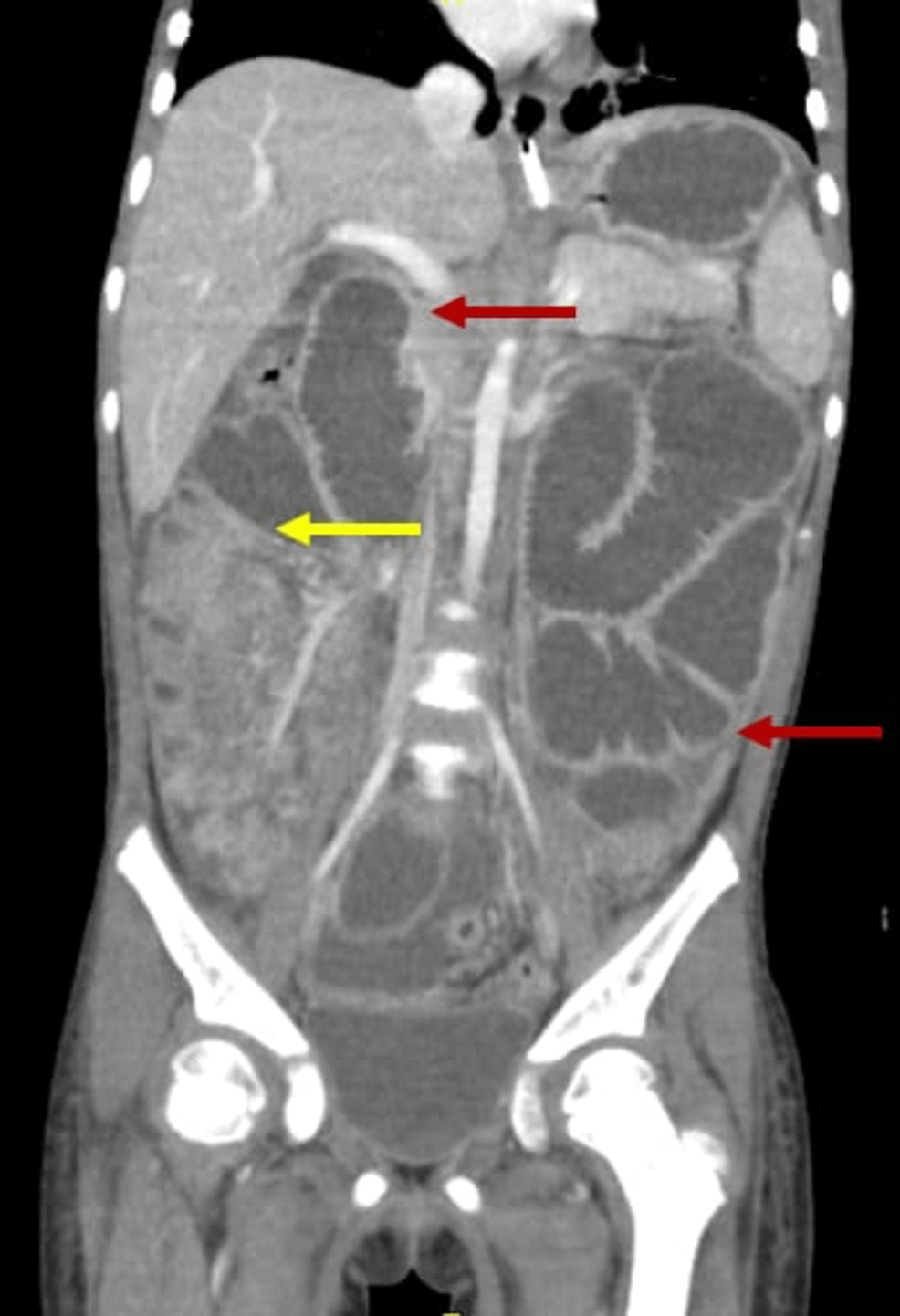 cureus-a-challenging-surgical-decision-in-a-child-with-bowel