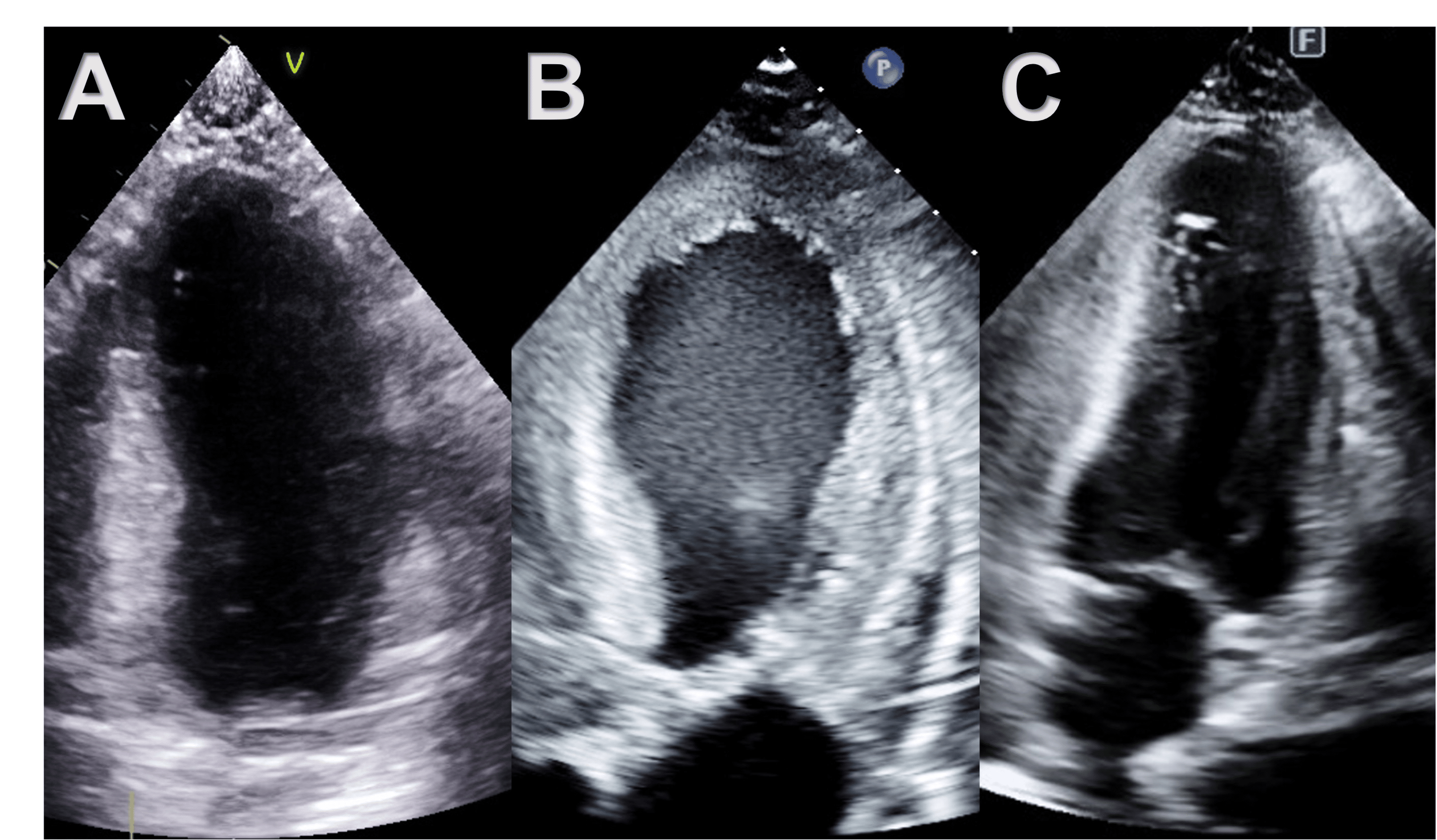 Postoperative Apical Ballooning Syndrome Following Orthotopic Liver