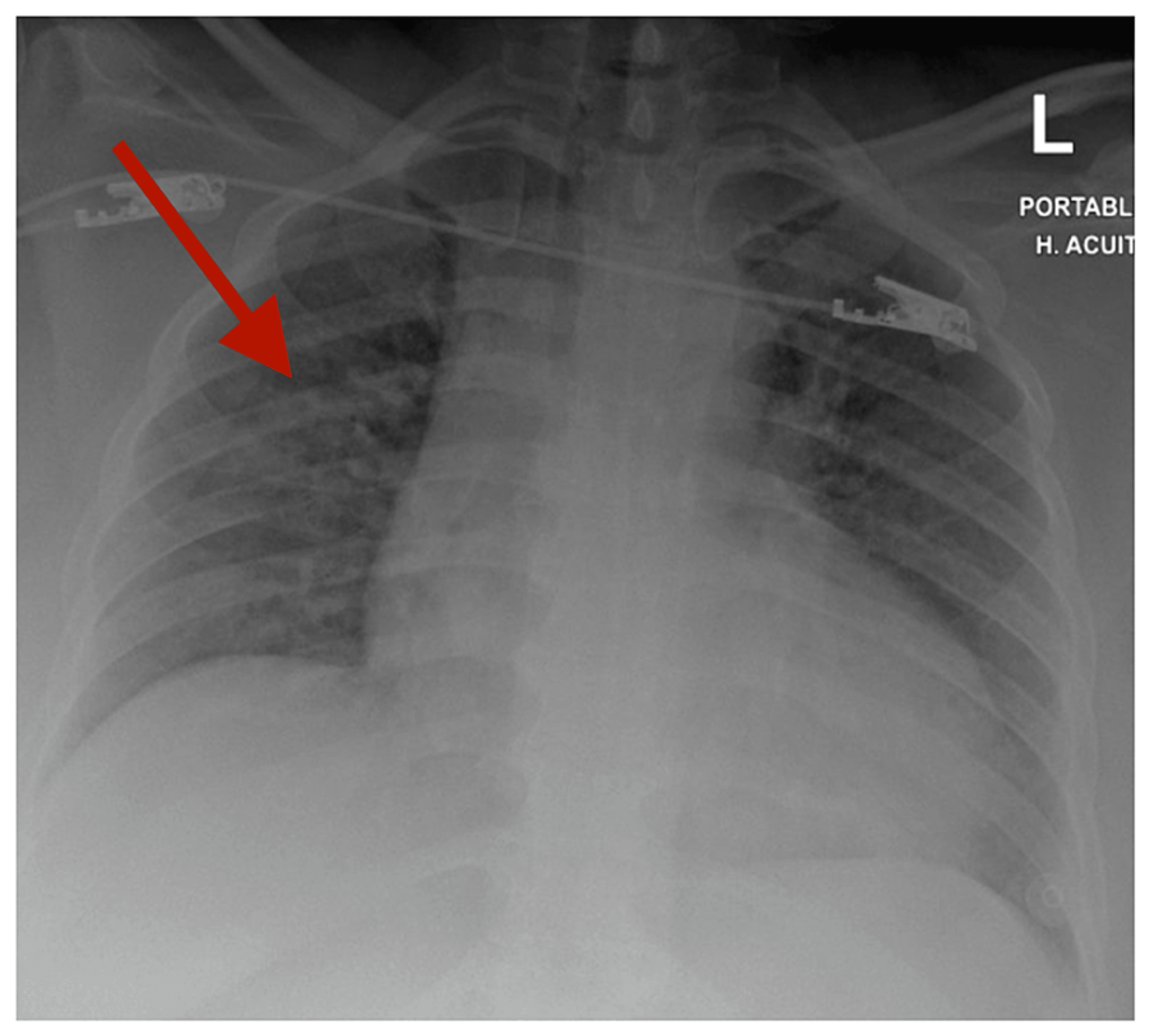 Cureus A Rare Case Of Diffuse Alveolar Hemorrhage Caused By Fentanyl