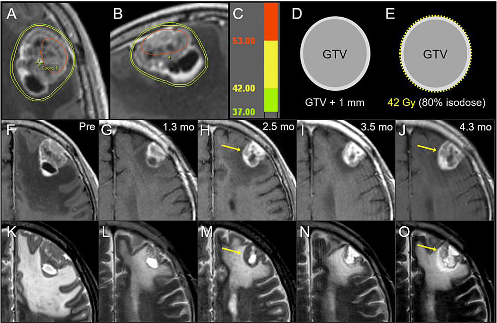 Cureus TenFraction Stereotactic Radiosurgery With Different Gross