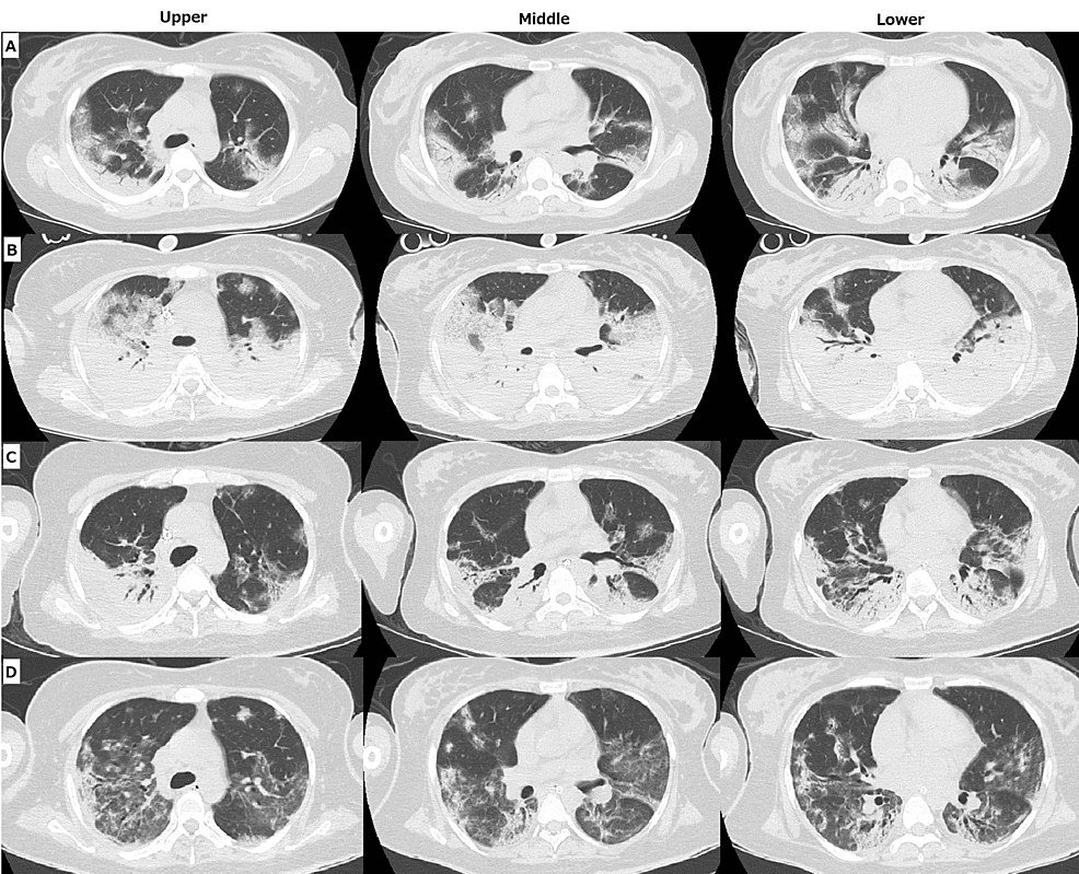 Cureus Successful of Mother and Baby in a Woman With Severe
