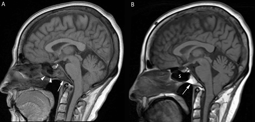 cureus-first-report-of-clivus-osteomyelitis-caused-by-nocardia