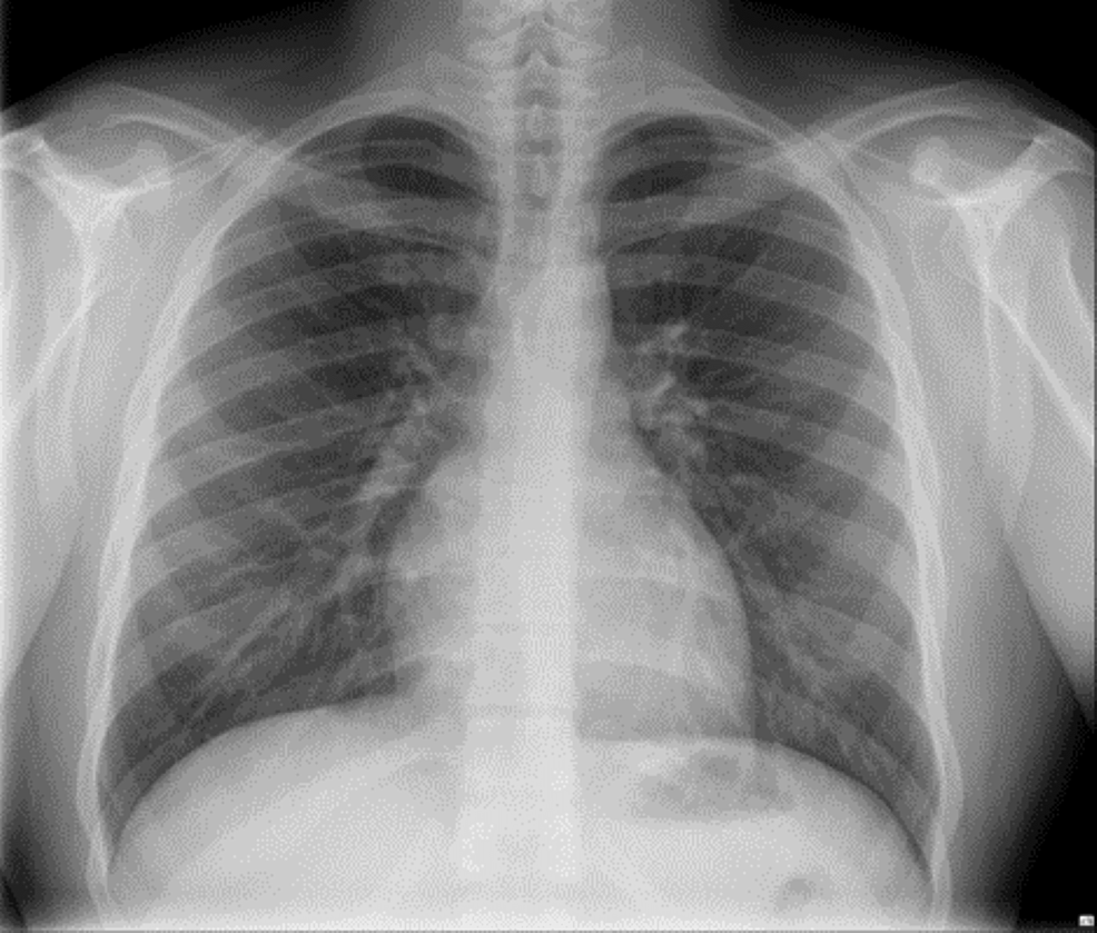 An Unusual Presentation of Eisenmenger Syndrome in a Middle-Aged Woman ...