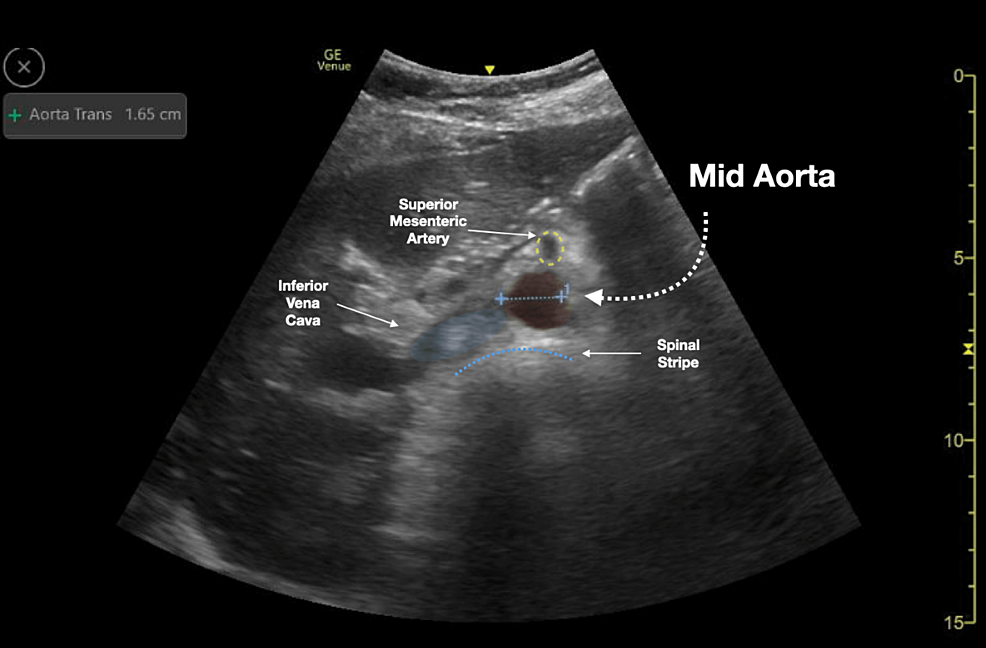 Mid-aorta-ultrasound