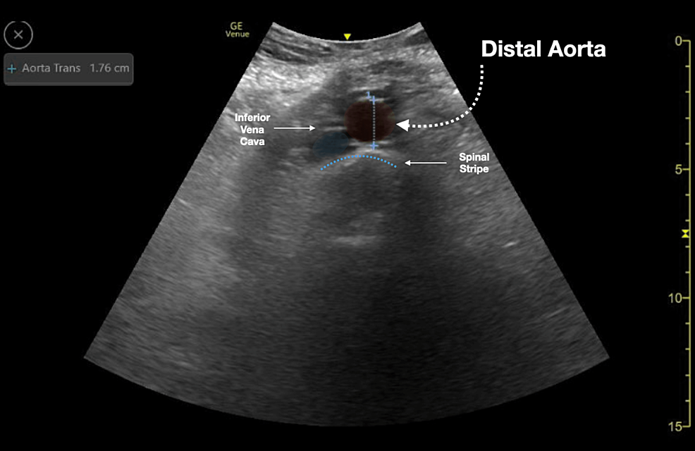 Distal-aorta-ultrasound