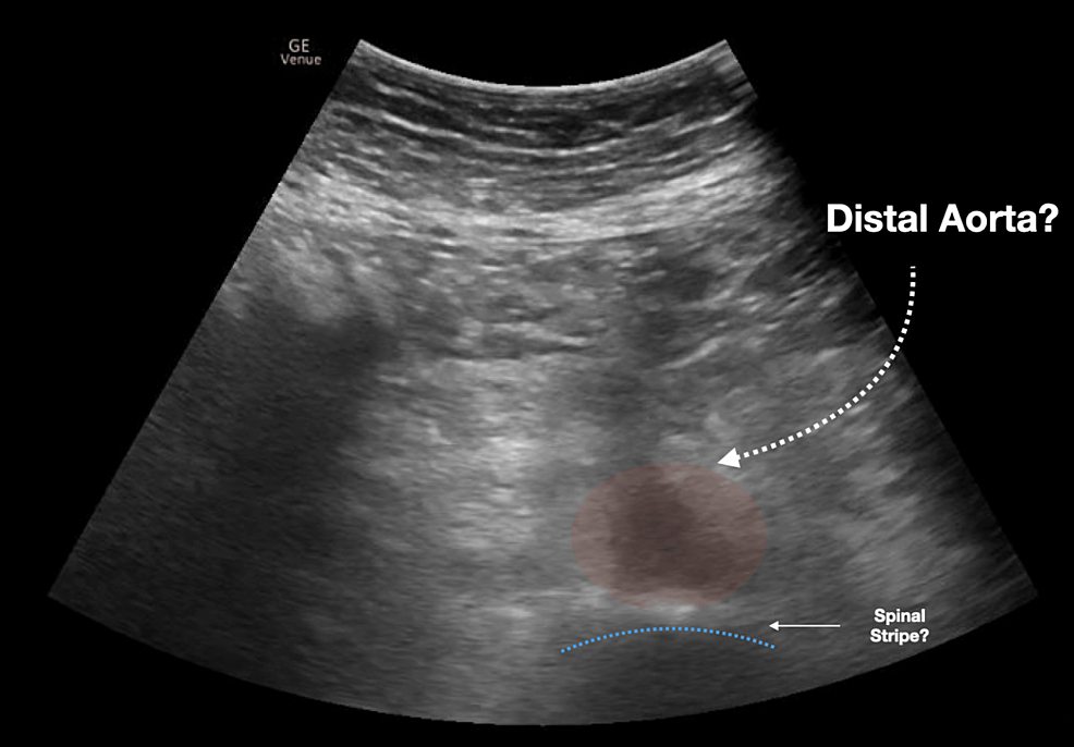 Difficult-to-visualize-the-distal-aorta