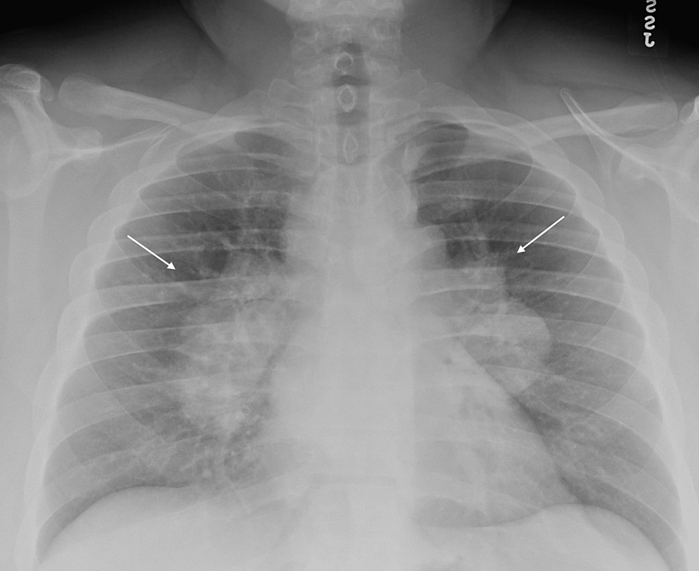 Severe Thrombocytopenia in a 30-Year-Old African American Male With ...