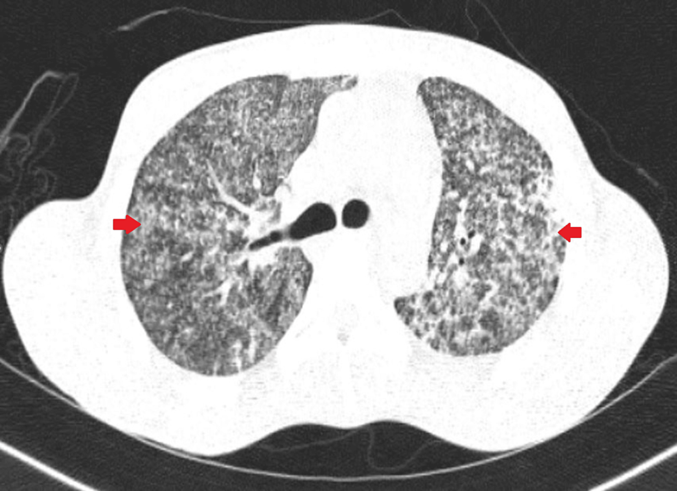 Cureus Miliary Tuberculosis with Acute Respiratory Distress Syndrome