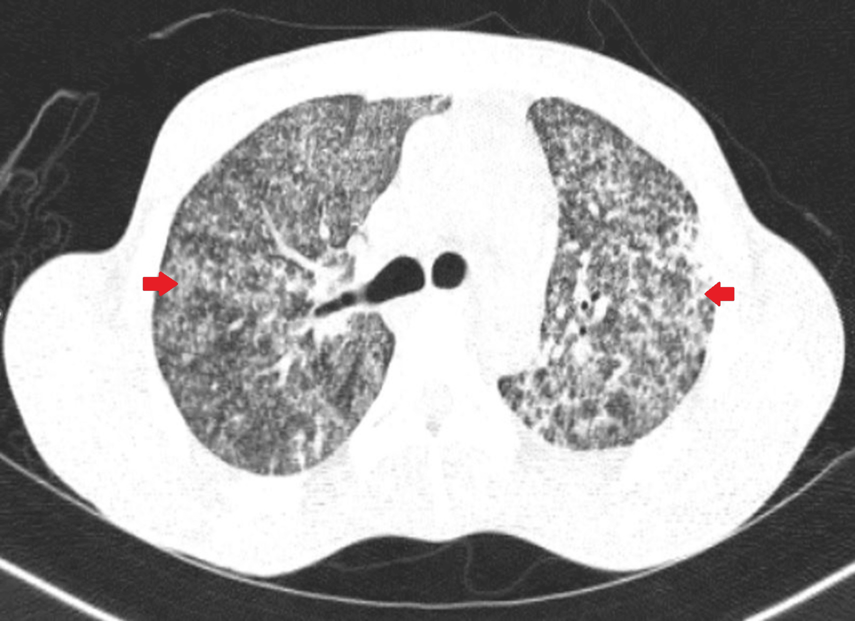 Miliary Tuberculosis With Acute Respiratory Distress Syndrome: A Deadly ...