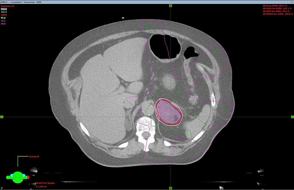 Adrenal-oligometastasis-stereotactic-body-radiotherapy-(SBRT)-planning-computed-tomography-(CT)-axial-view.