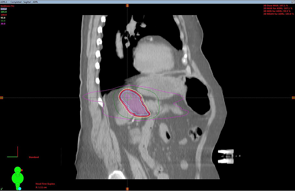 Adrenal-oligometastasis-stereotactic-body-radiotherapy-(SBRT)-planning-computed-tomography-(CT)-sagittal-view.