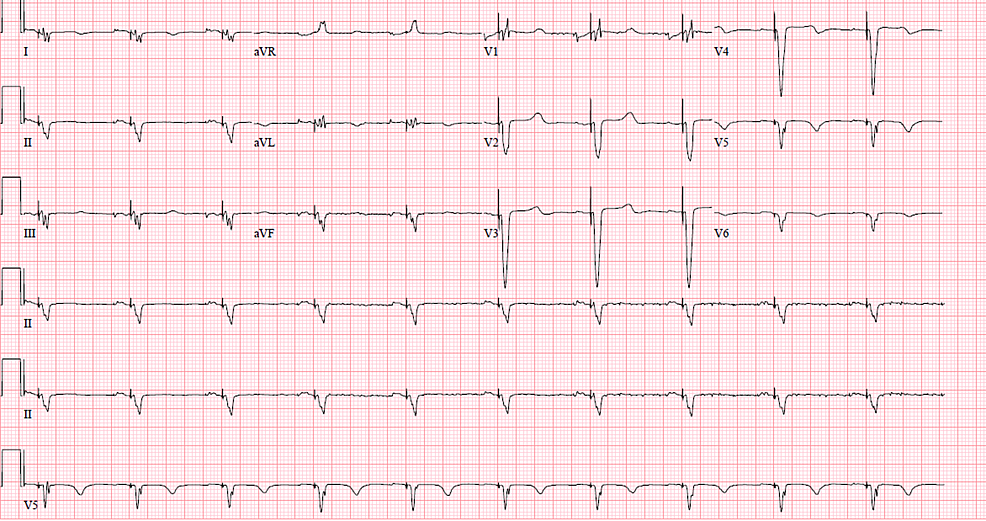 Biventricular-pacing-observed.