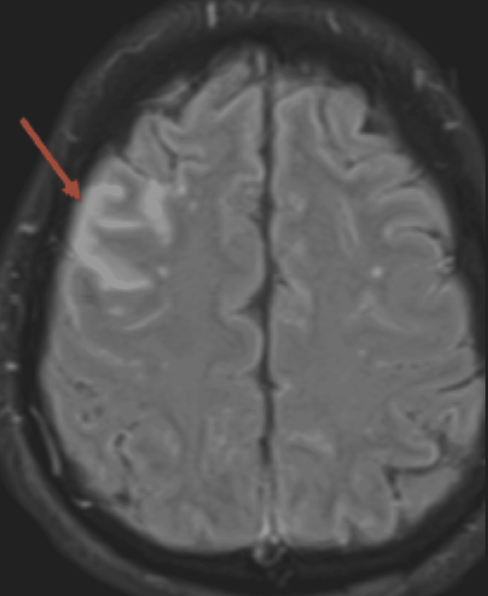 a-sharp-rise-in-autoimmune-encephalitis-in-the-covid-19-era-a-case