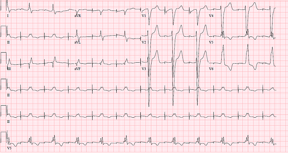 Atrial-paced-rhythm,-loss-of-ventricular-pacing.