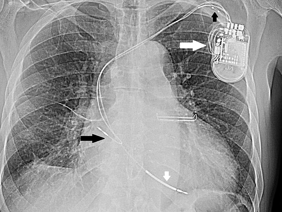Long-white-arrow-shows-spool-of-wire-near-device-not-seen-earlier.-Small-black-arrow-shows-coiled-up-left-coronary-sinus-lead,-small-white-arrow-points-to-pulled-up-RV-lead,-long-black-arrow-shows-pulled-up-RA-lead.