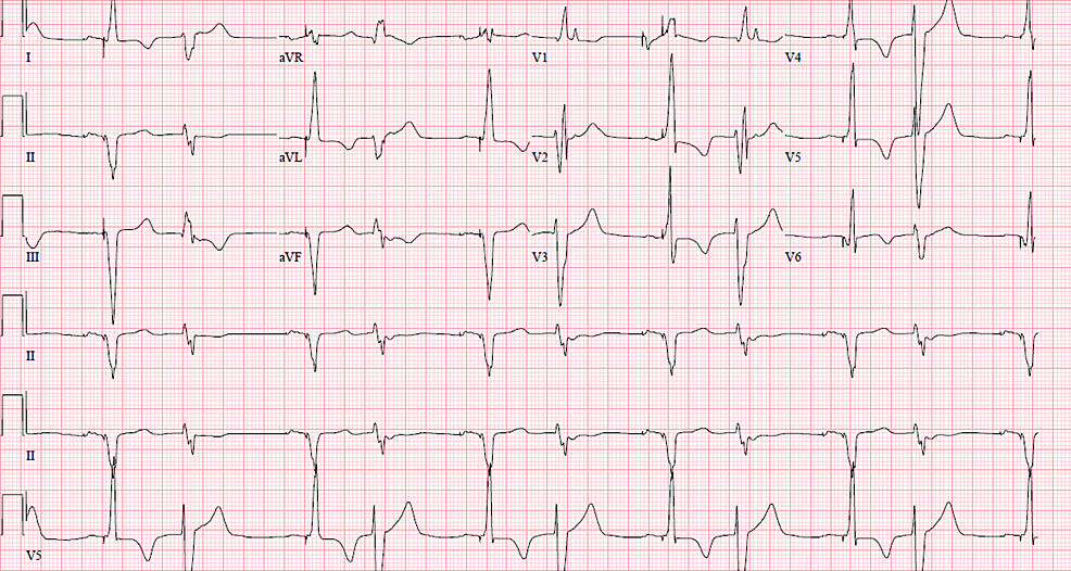 Appropriate-biventricular-pacing.