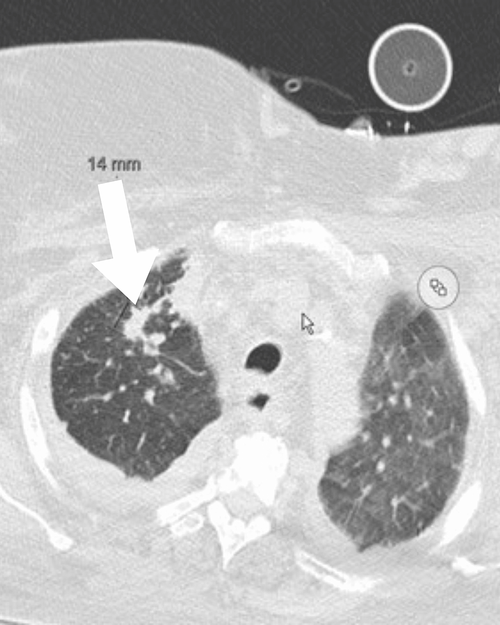 cureus-the-value-of-a-negative-pleural-fluid-cytology-and-biopsy-in