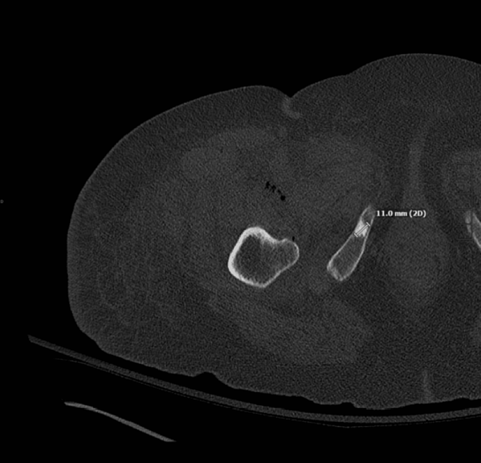 A Case Report Of Iliopsoas Abscess Secondary To Small Bowel Fistula ...