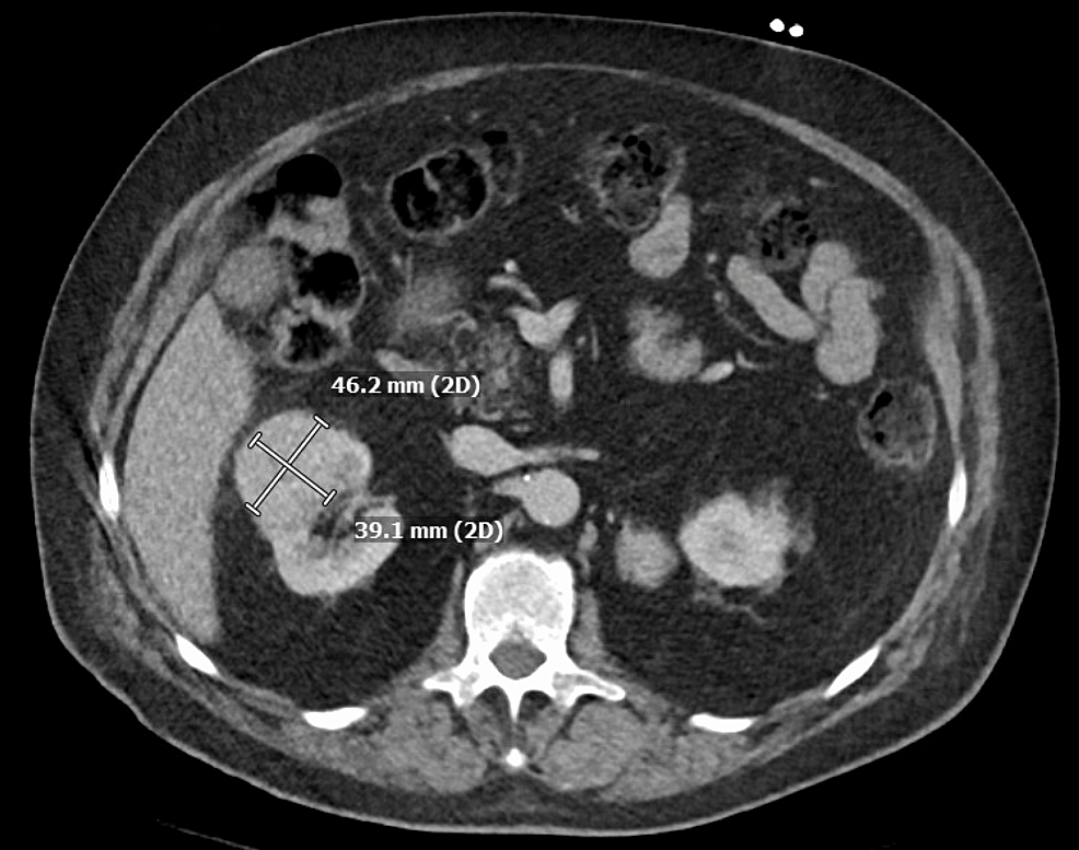 Cureus A Case of Retroperitoneal Paraganglioma Presenting As