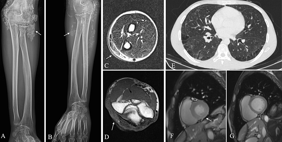 Systemic-involvement-of-scleromyositis