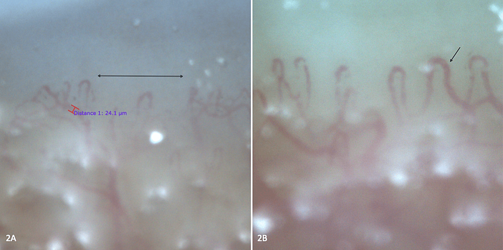 Nailfold-capillaroscopy-(200x)-evolution