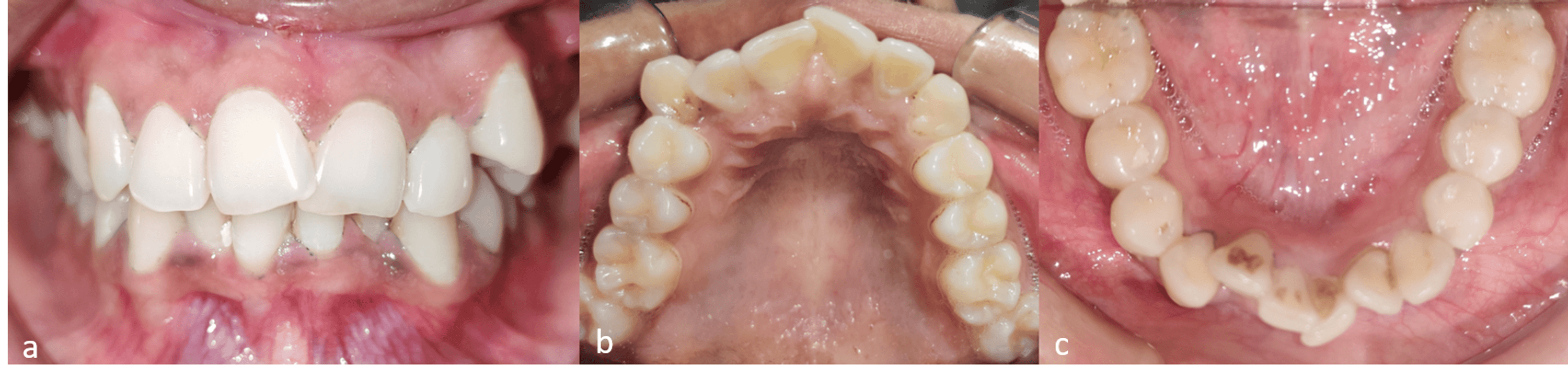 Cureus Nonextraction Orthodontic Treatment Protocol of Moderate Crowding