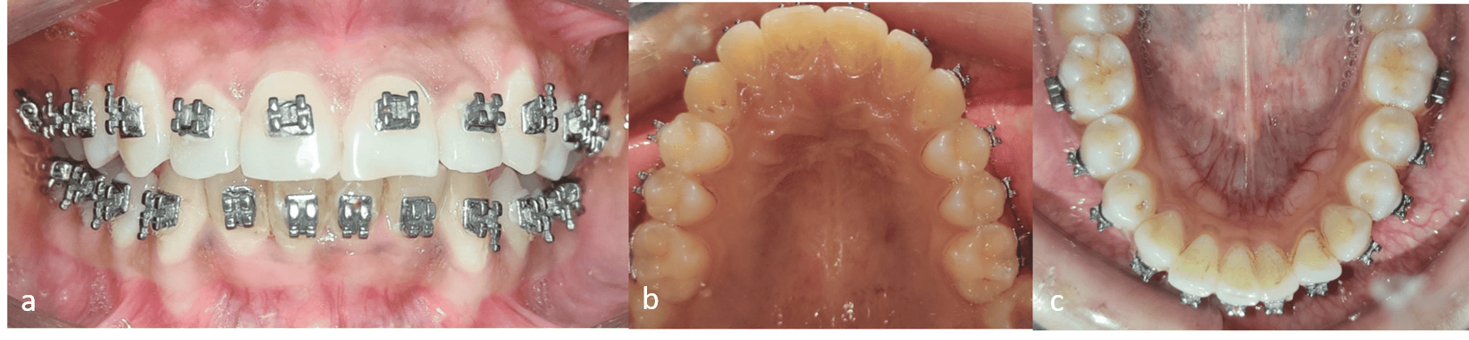 Cureus Nonextraction Orthodontic Treatment Protocol of Moderate Crowding