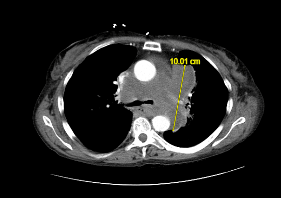 CT-chest-with-IV-contrast
