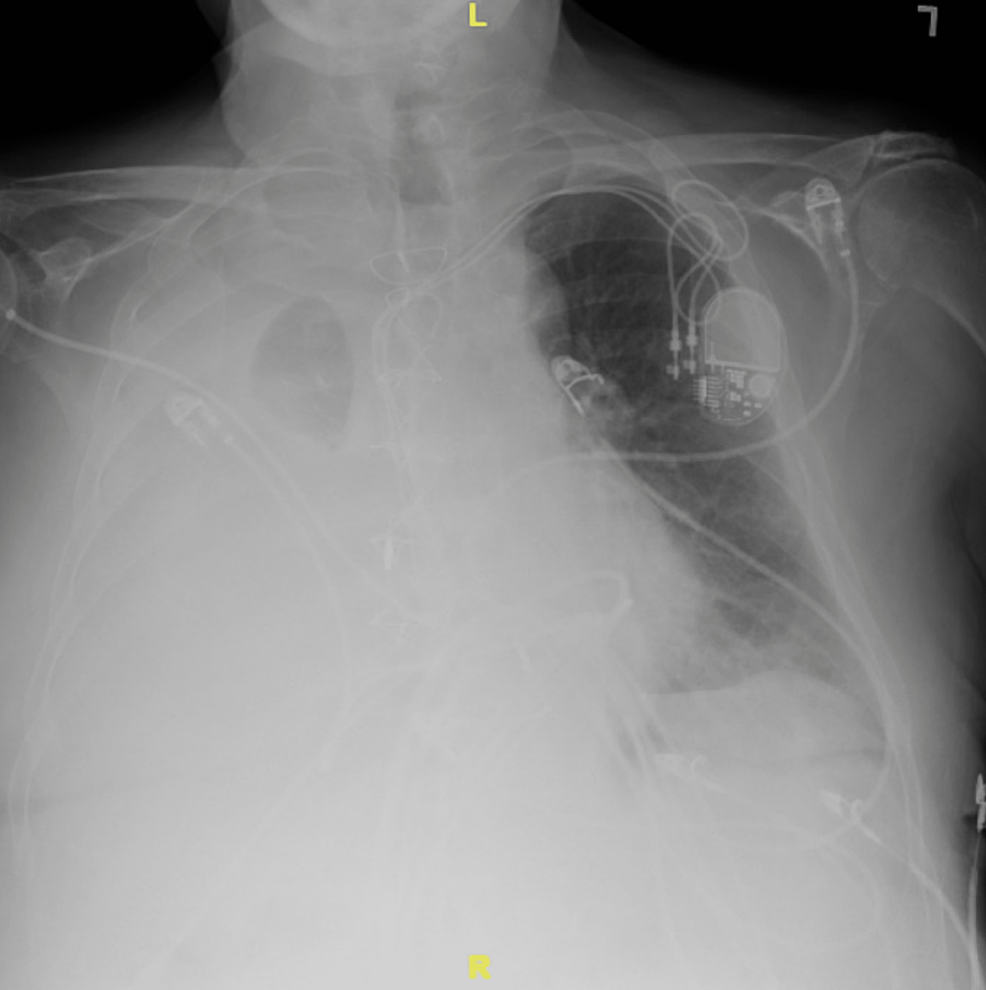 cureus-acute-liver-failure-secondary-to-pyogenic-hepatic-abscess