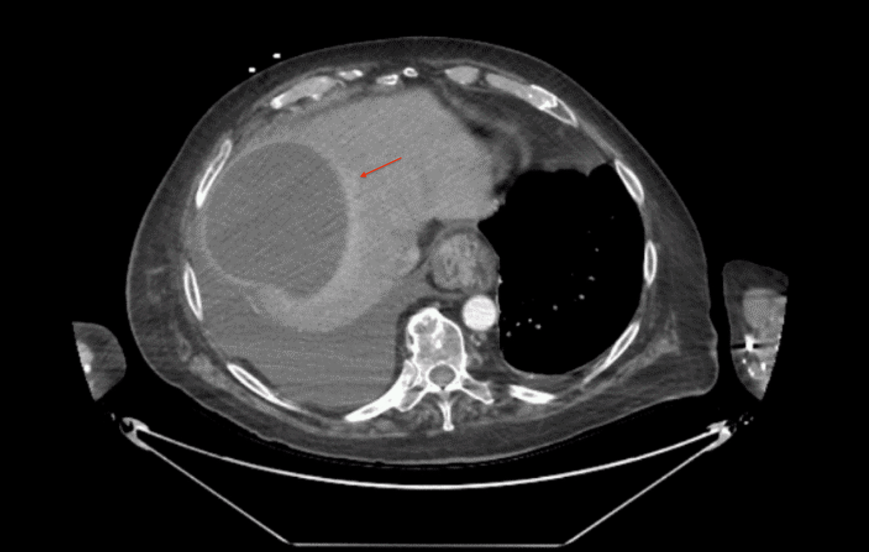 Acute Liver Failure Secondary to Pyogenic Hepatic Abscess Cureus