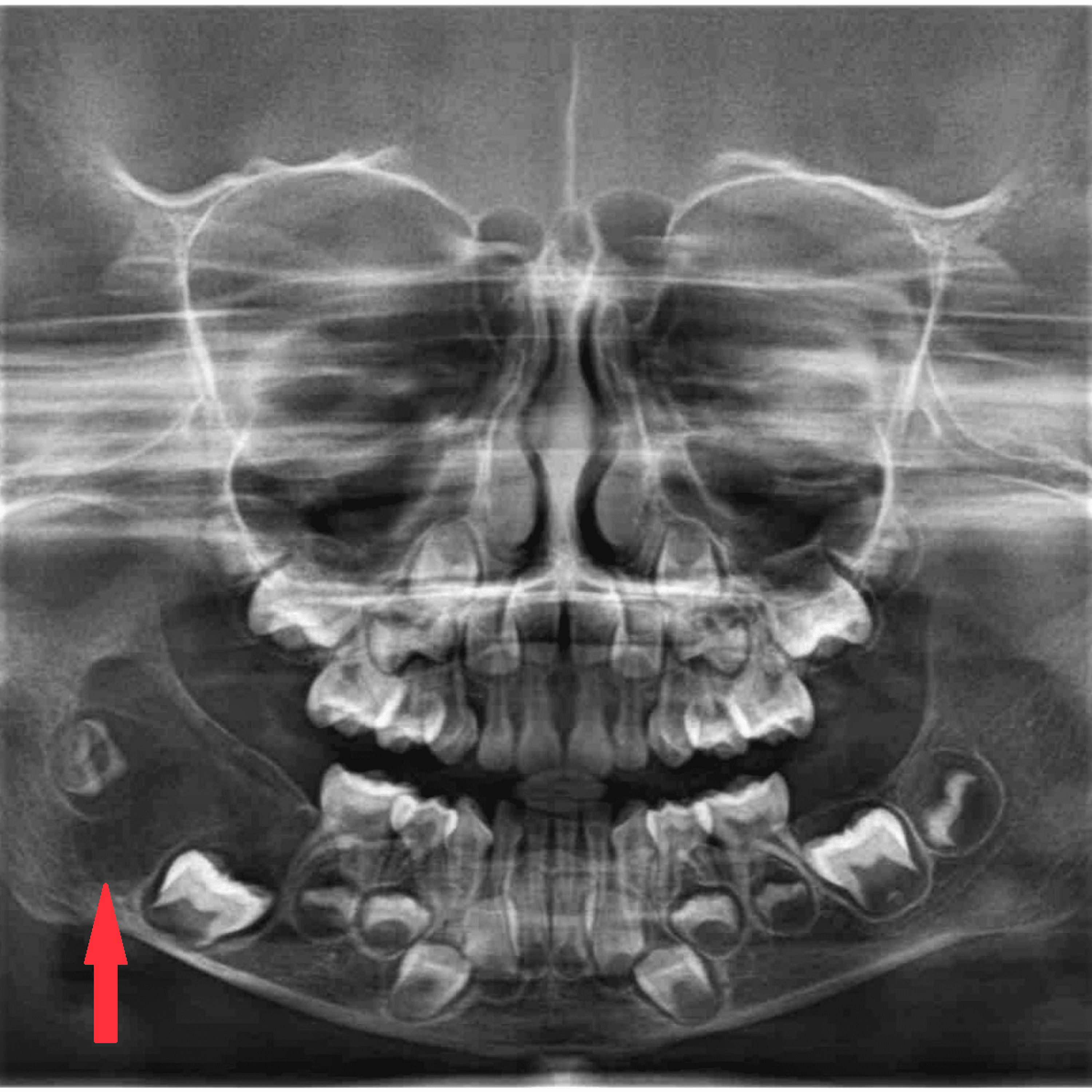 Cureus | Non-ossifying Fibroma of Mandible in a Four-Year-Old Girl: A ...