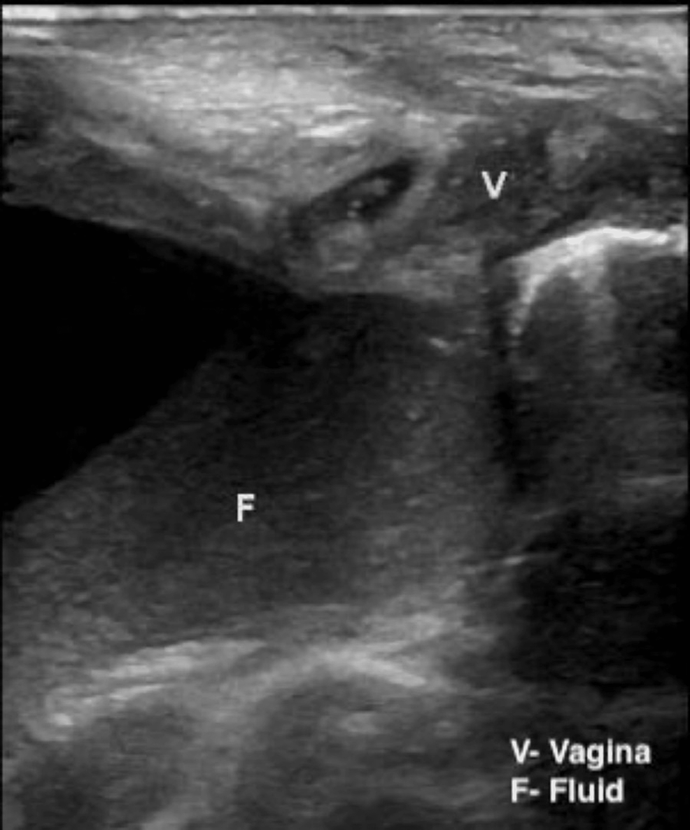 Cureus Hydrometrocolpos With Polydactyly in Consanguineous Parents A
