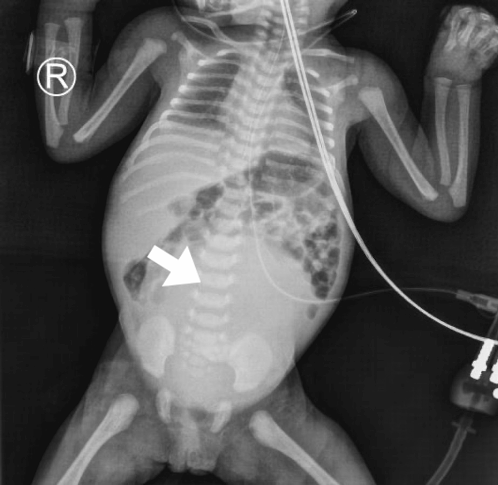 Cureus Hydrometrocolpos With Polydactyly in Consanguineous Parents A