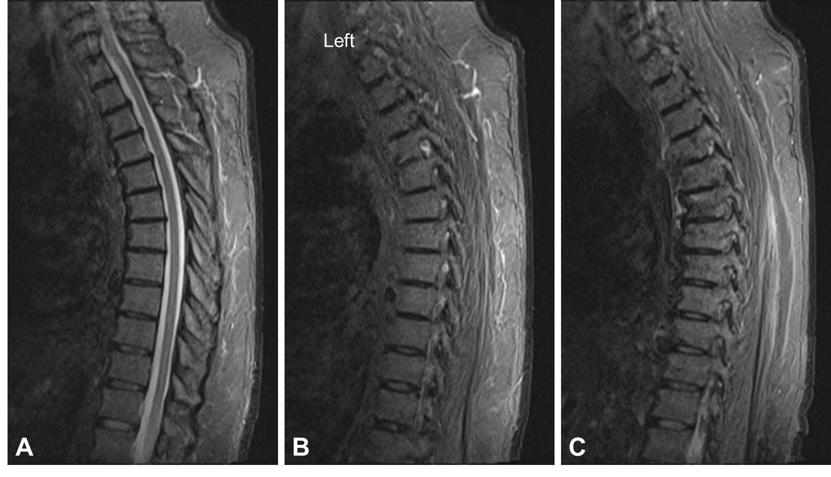 Cureus | Successful Treatment of a Three-Column Thoracic Extension ...