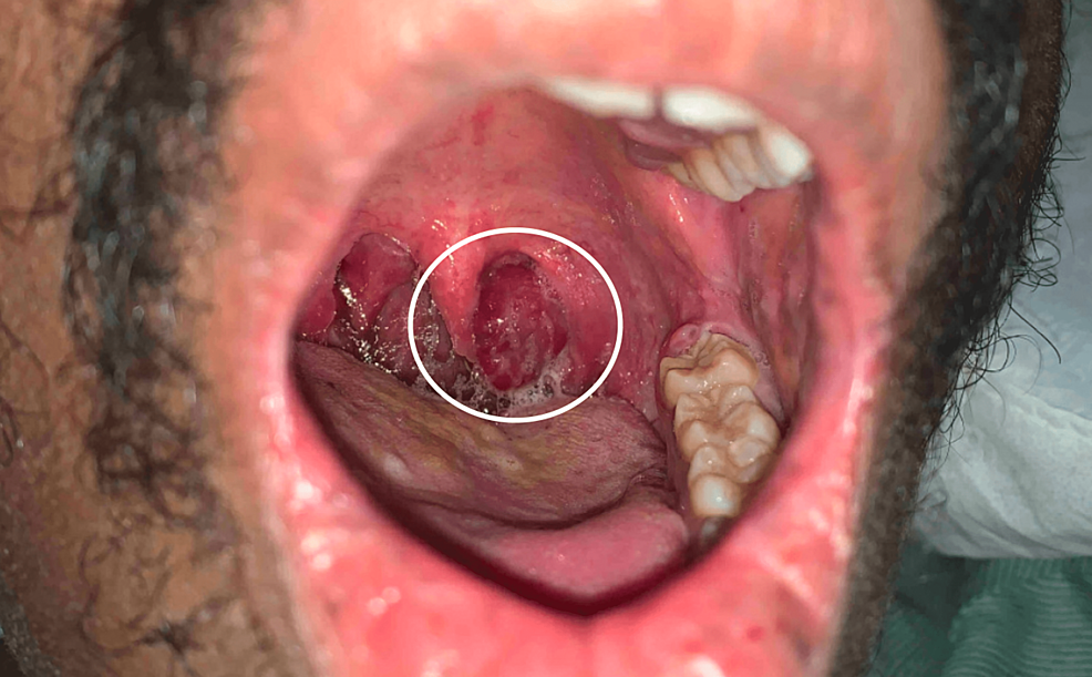 Immune Reconstitution Inflammatory Syndrome Presenting As Disseminated