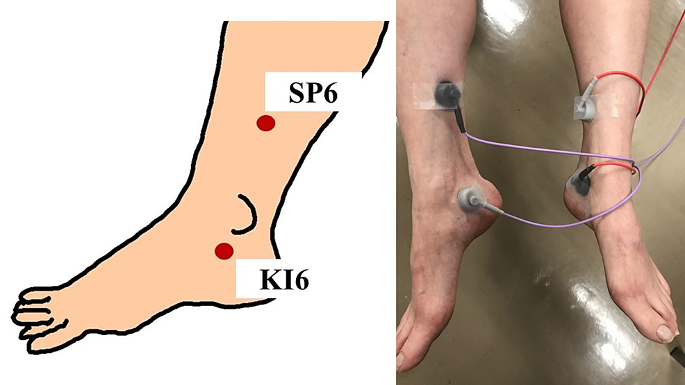 Comparison of Effects of Transcutaneous Electrical Nerve Stimulation(TENS)  and San-Yin-Jiao(SP6) Acupressure on Primary Dysmenorrhea