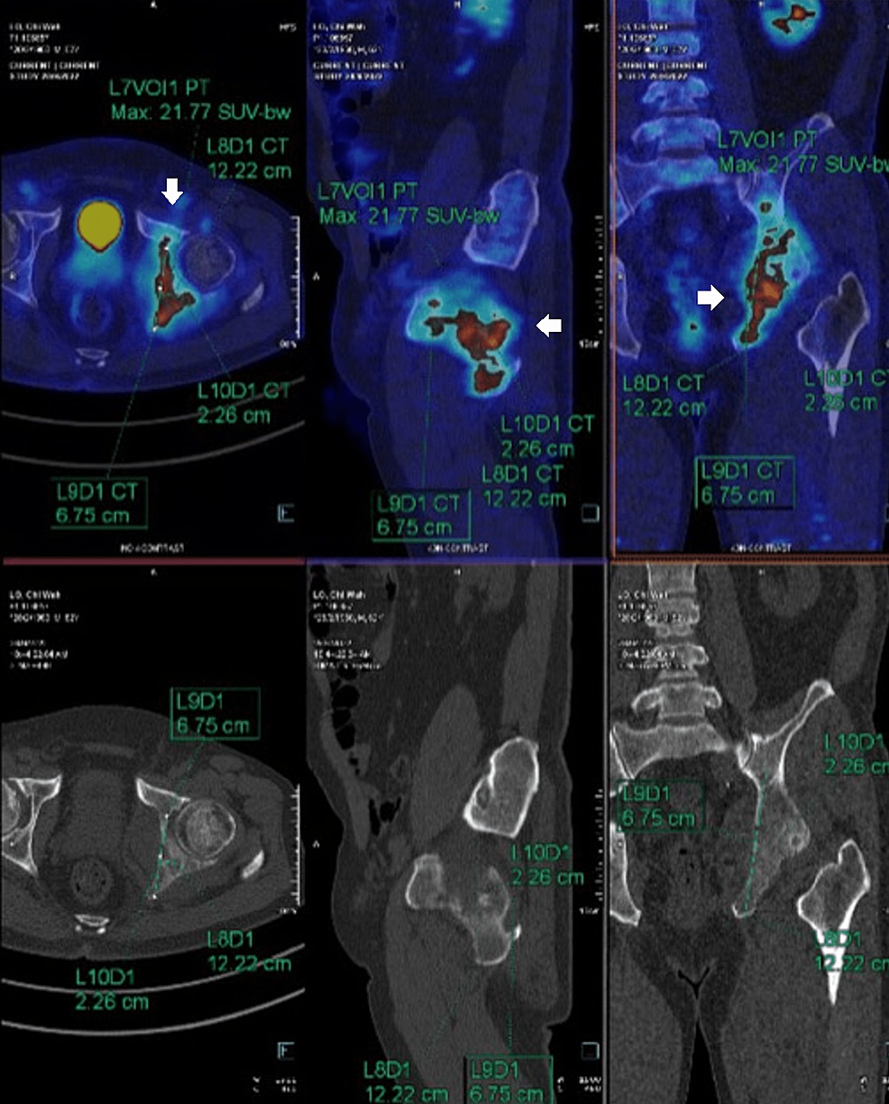 F18-PSMA-whole-body-PET-and-CT