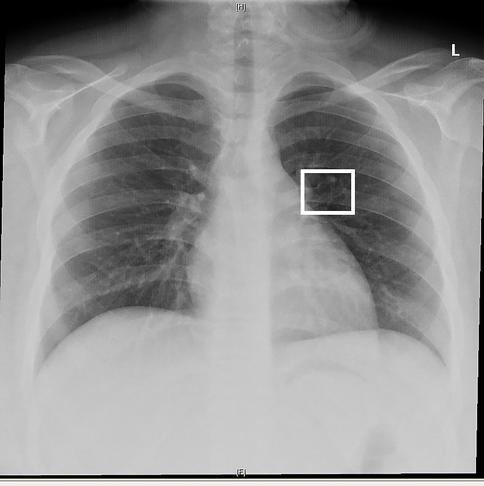Chest x ray radiology picture