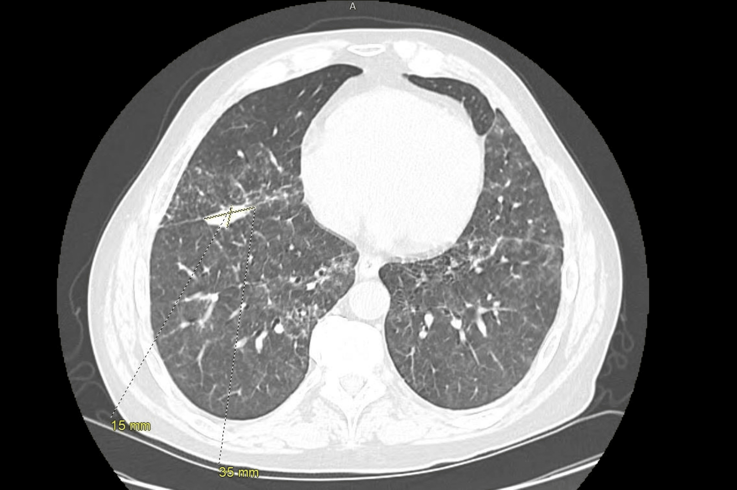 Cureus | Type 1 Pulmonary Hypertension and Silicosis in a Bluestone ...